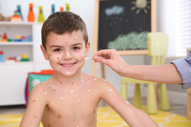 Photo of Woman applying cream onto skin of little boy with chickenpox at home