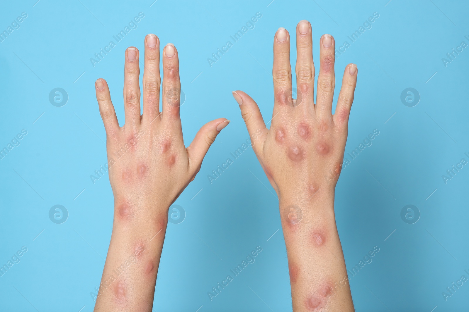 Photo of Woman with rash suffering from monkeypox virus on light blue background, closeup