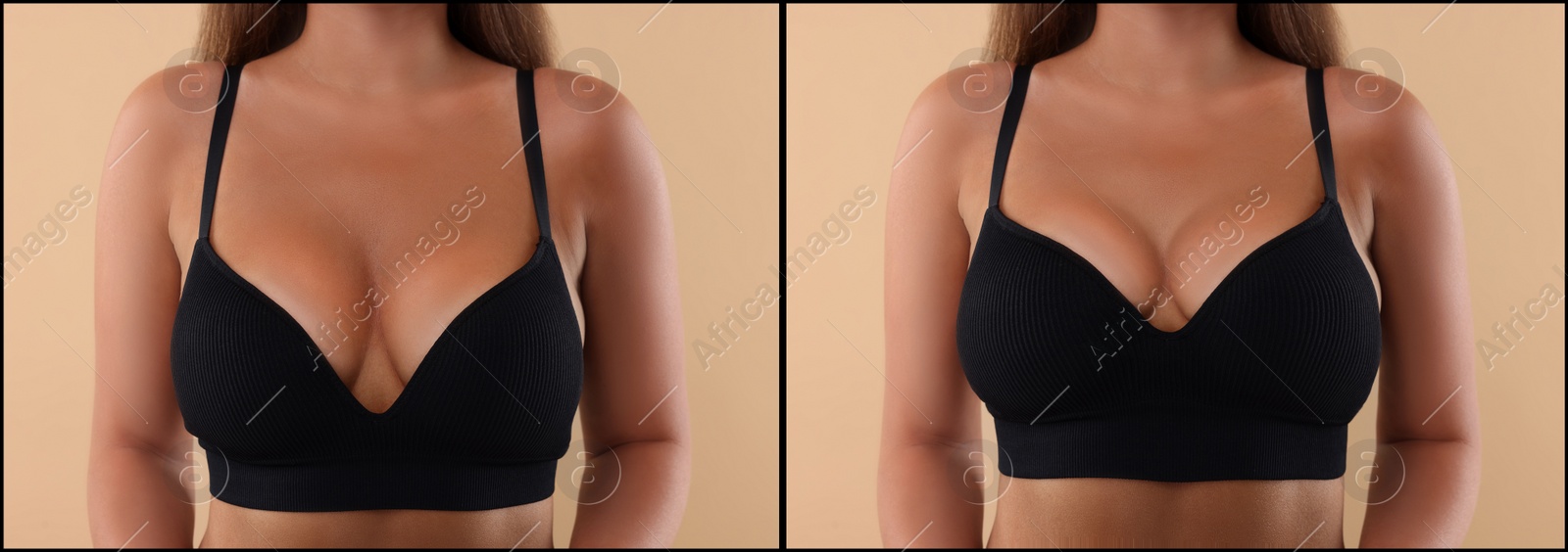 Image of Collage with photos of woman before and after breast-lift surgery on beige background, closeup