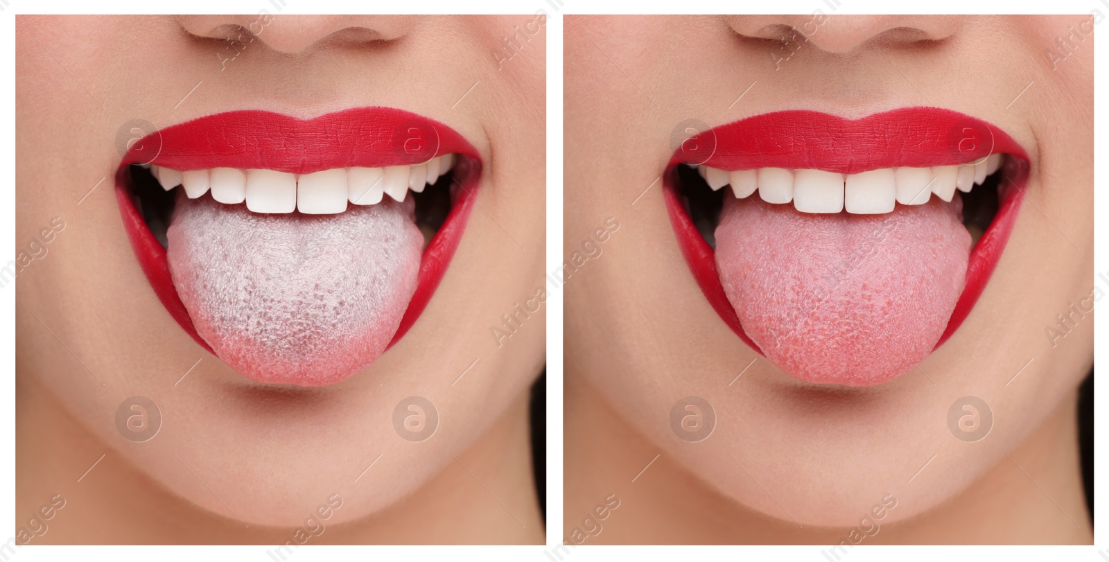 Image of Collage with photos of woman before and after tongue cleaning, closeup