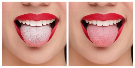 Image of Collage with photos of woman before and after tongue cleaning, closeup