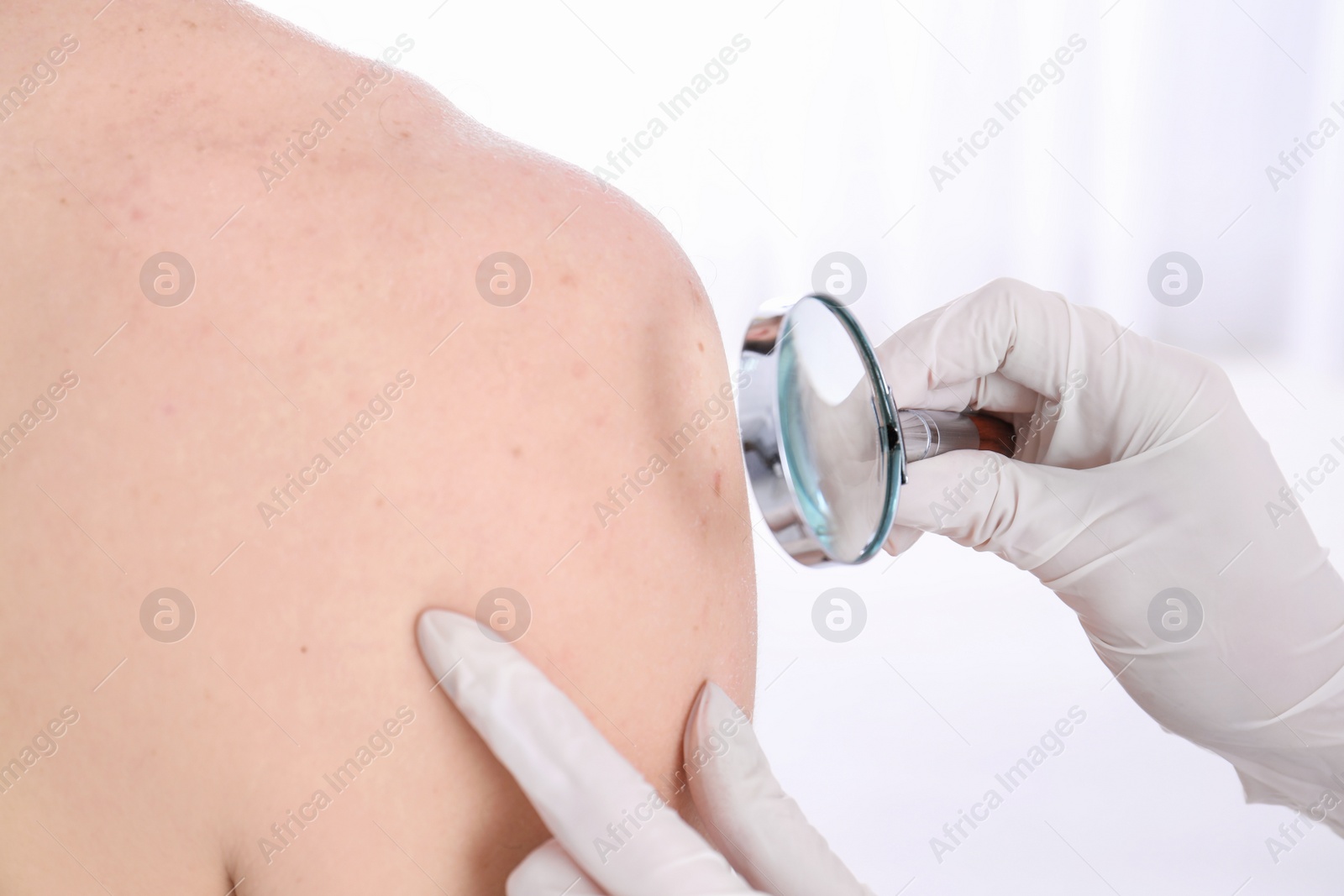 Photo of Dermatologist examining patient with magnifying glass in clinic, closeup view