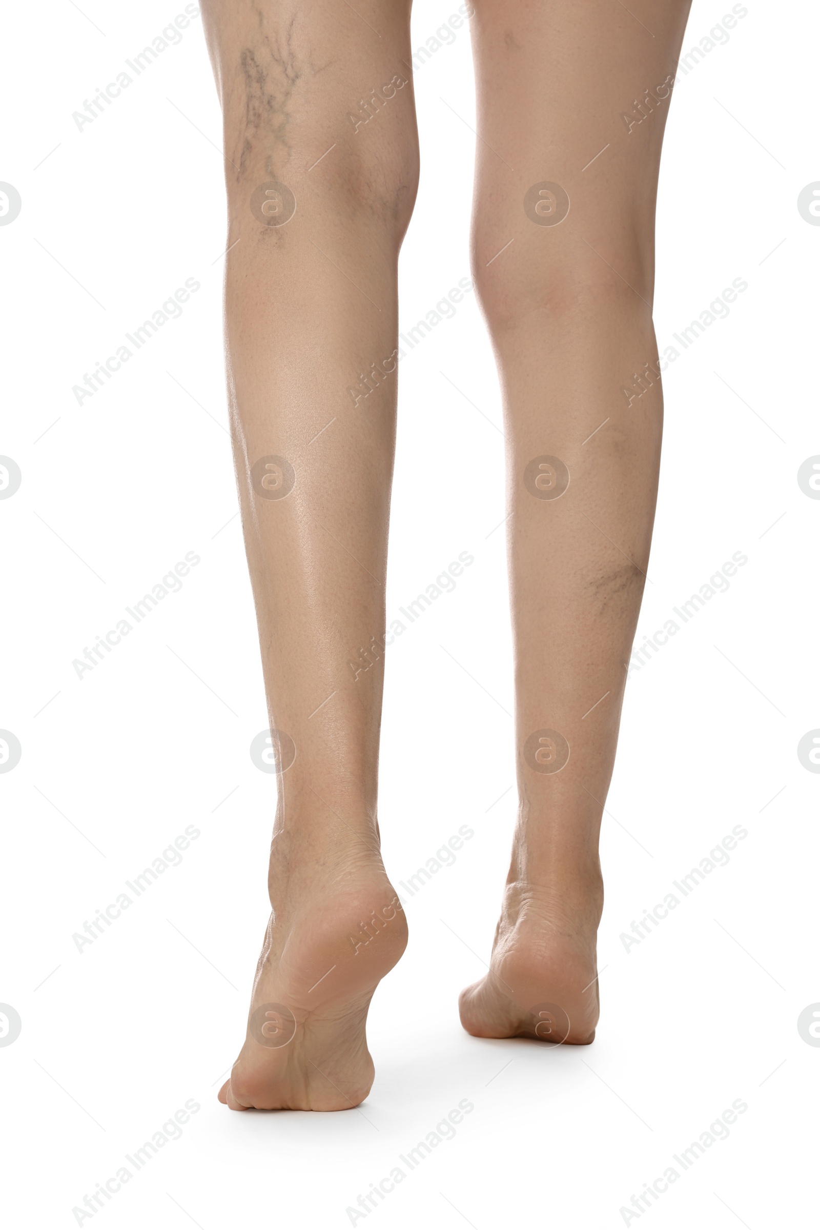 Photo of Closeup view of woman with varicose veins on white background