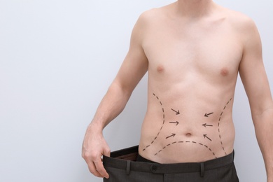 Photo of Young man with marks on belly for cosmetic surgery operation on light background