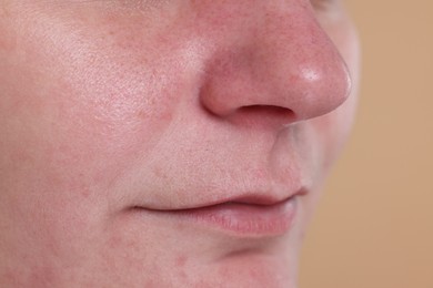 Photo of Closeup view of woman with blackheads on her nose against beige background