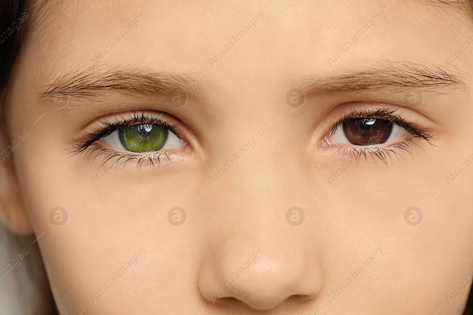 Image of Little girl with different colors of eyes, closeup. Heterochromia iridis