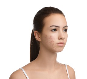 Teenage girl with acne problem on white background