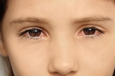 Image of Little child suffering from conjunctivitis, closeup view