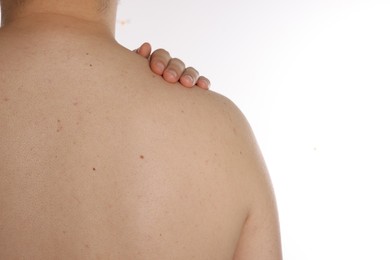 Closeup of man's body with birthmarks on white background, back view. Space for text