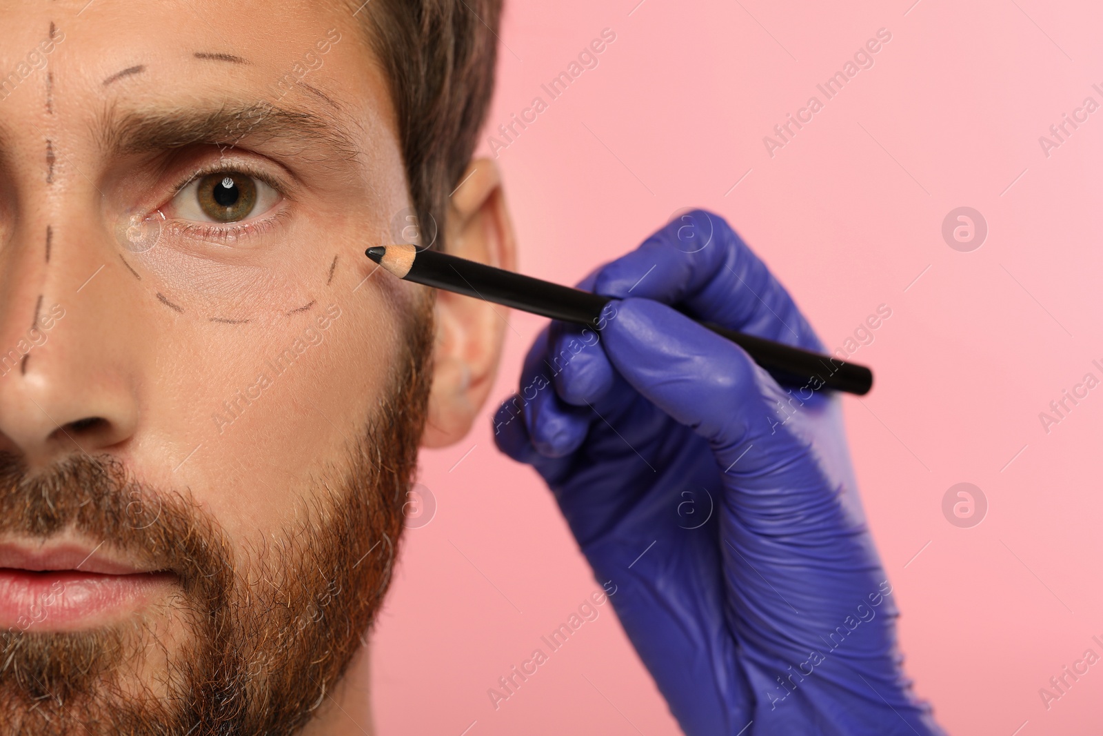 Photo of Doctor with pencil preparing patient for cosmetic surgery operation on pink background, closeup