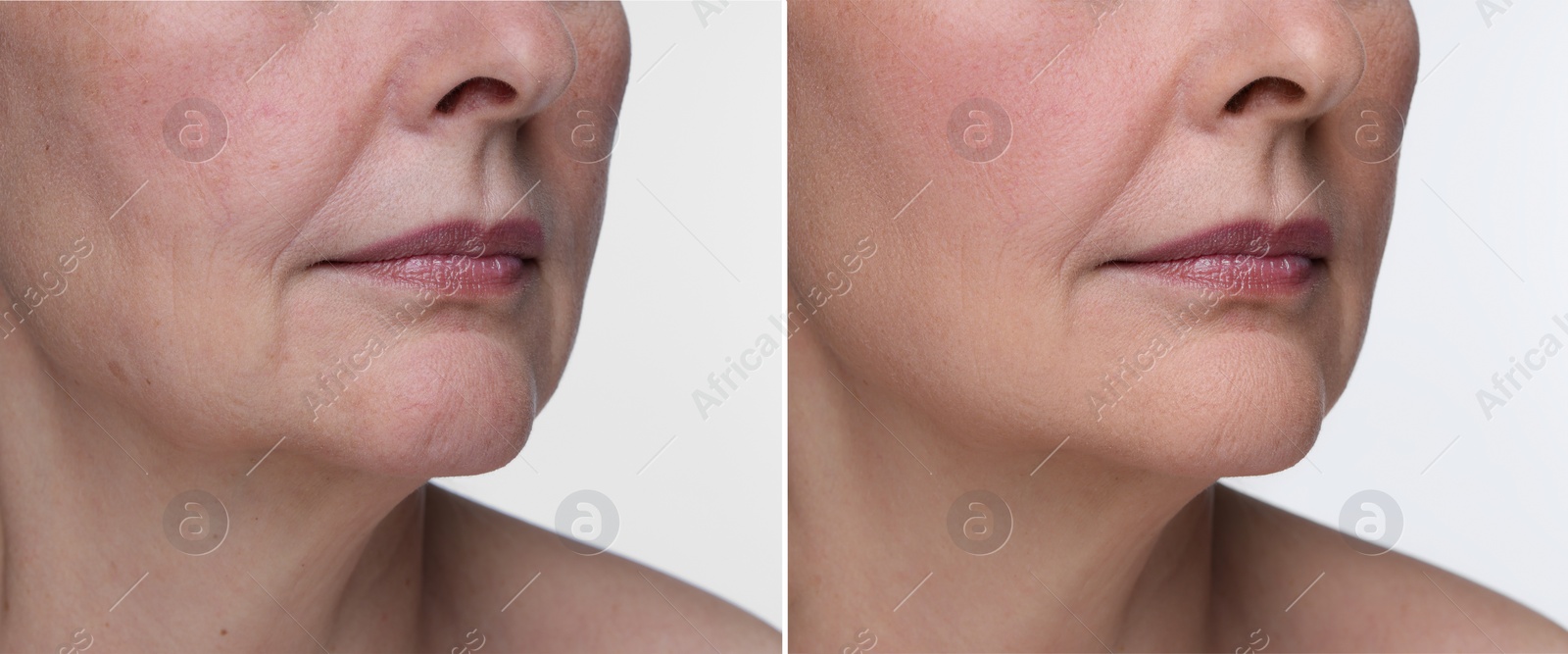 Image of Aging skin changes. Collage with photos of mature woman before and after cosmetic procedure on white background, closeup