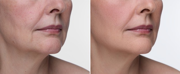 Image of Aging skin changes. Collage with photos of mature woman before and after cosmetic procedure on white background, closeup