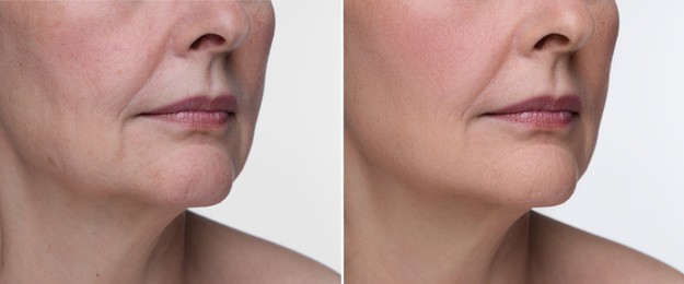 Aging skin changes. Collage with photos of mature woman before and after cosmetic procedure on white background, closeup