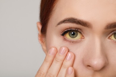 Woman with yellow eyes on light grey background, closeup. Symptom of hepatitis