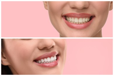 Image of Woman showing teeth before and after whitening on pink background, collage