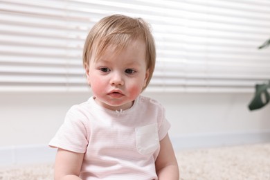 Photo of Portrait of little girl with diathesis symptom on cheeks indoors