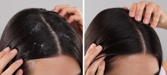 Woman showing hair before and after dandruff treatment on grey background, collage