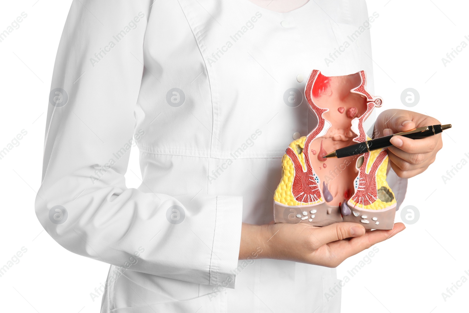 Photo of Doctor pointing at model of unhealthy lower rectum with inflamed vascular structures on white background, closeup. Hemorrhoid problem