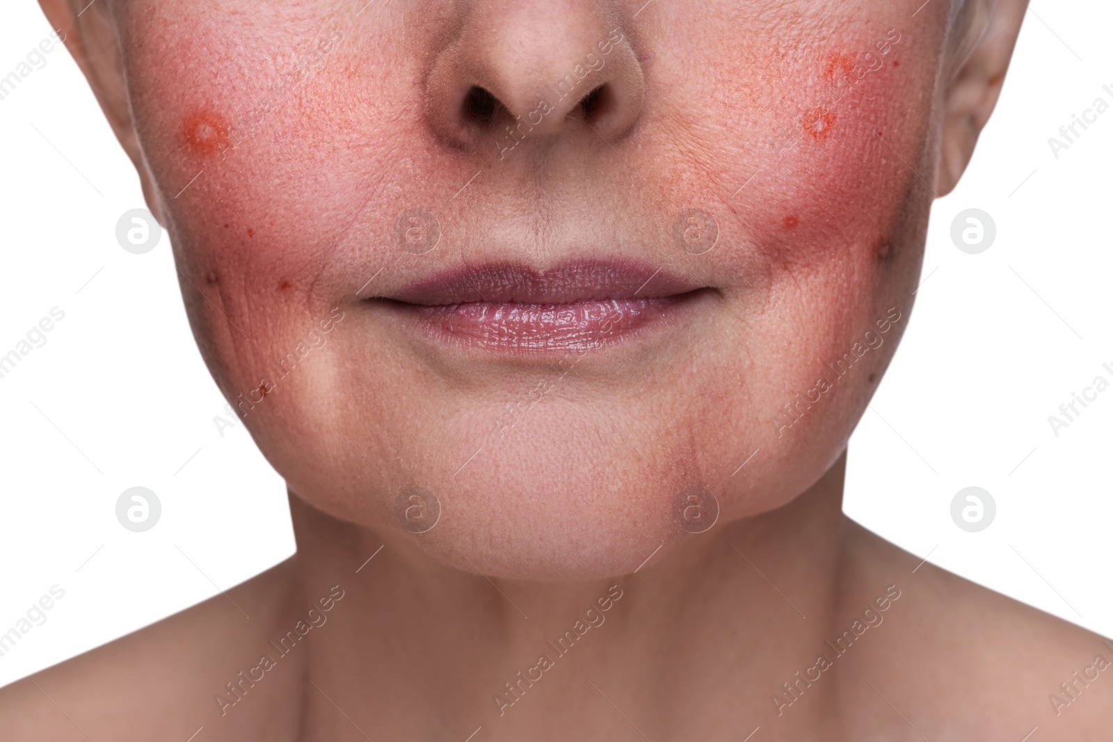 Image of Woman with rosacea on white background, closeup. Problem skin treatment