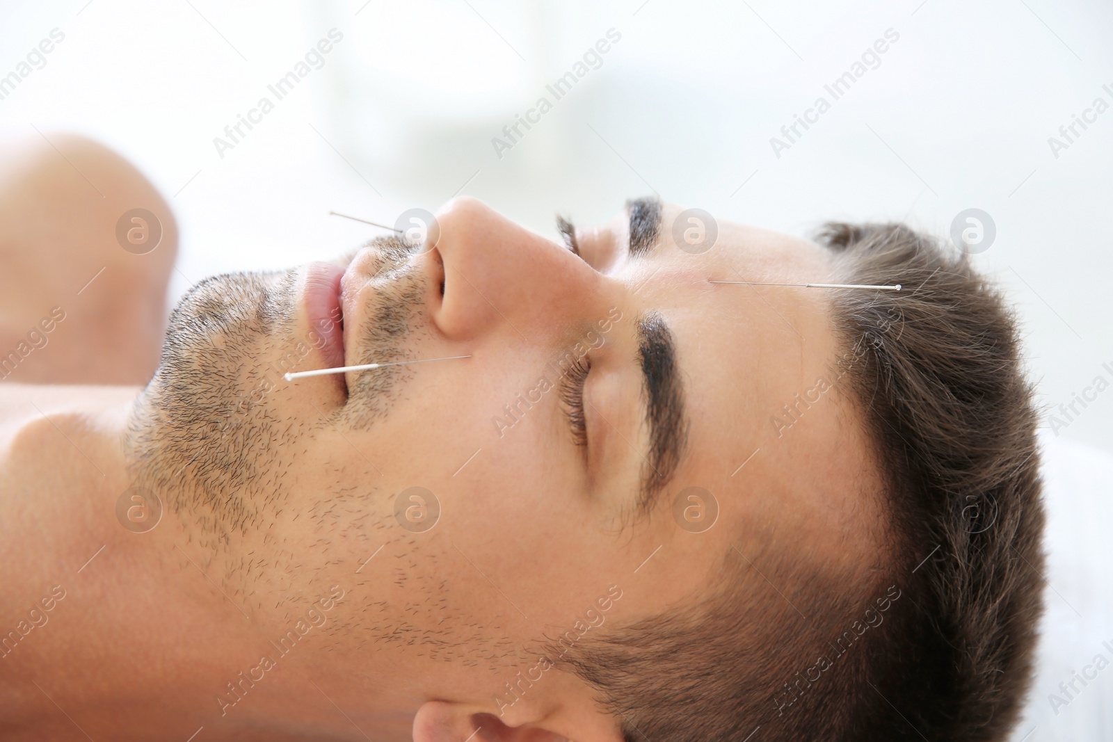 Photo of Young man undergoing acupuncture treatment in salon, closeup