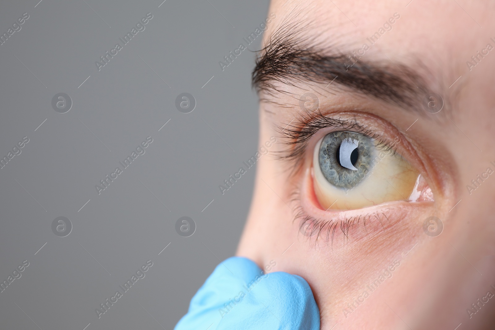 Photo of Doctor checking woman with yellow eyes on grey background, closeup. Symptom of hepatitis