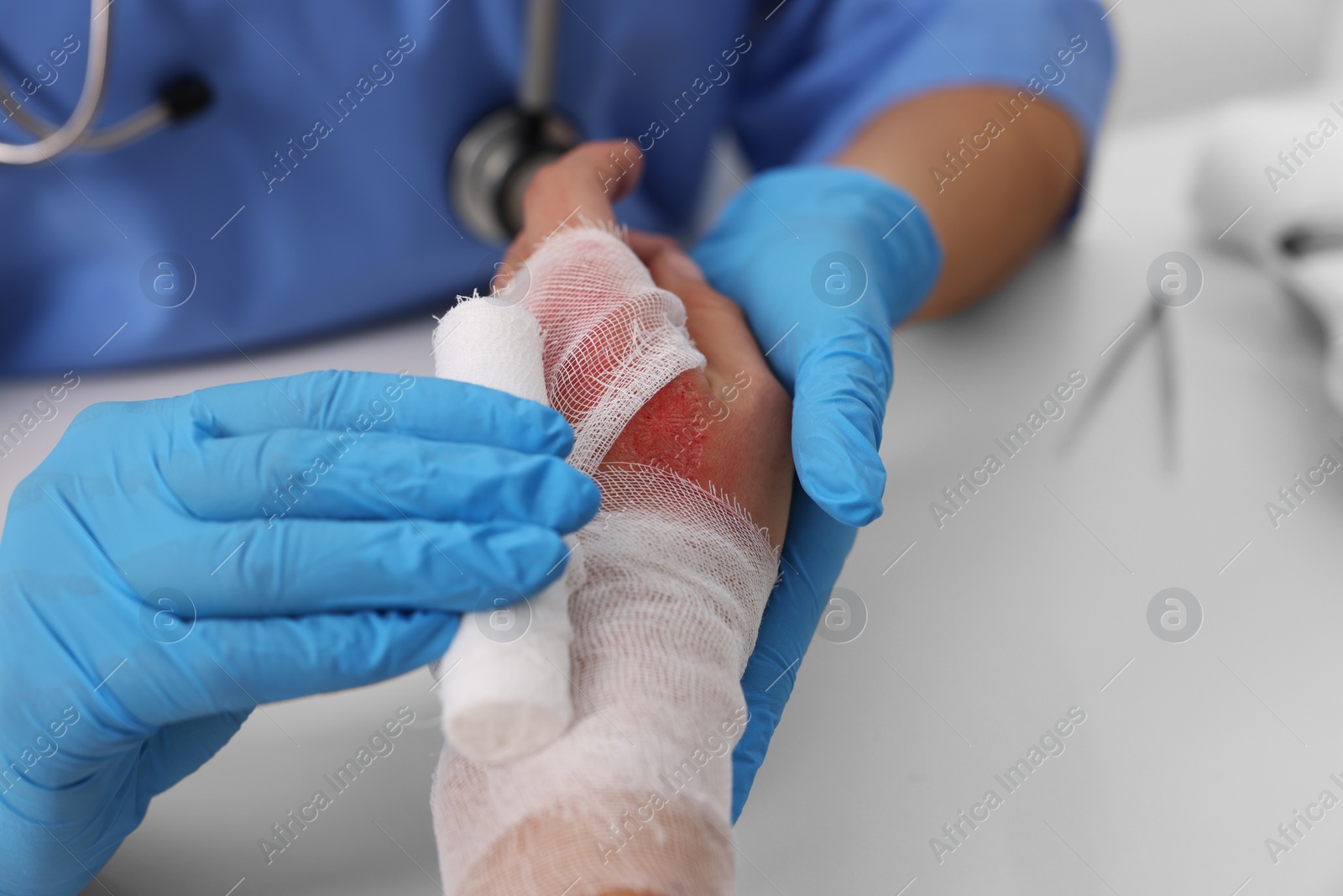 Photo of Doctor bandaging patient's burned hand at table, closeup