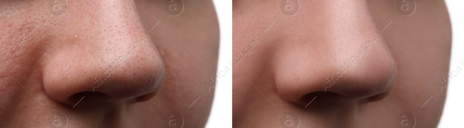 Image of Before and after acne treatment. Photos of woman on white background, closeup. Collage showing affected and healthy skin