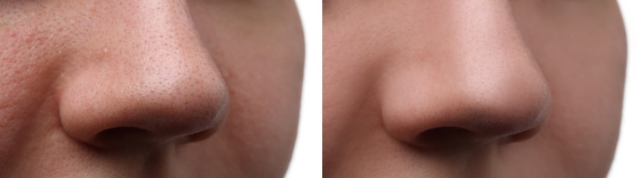 Before and after acne treatment. Photos of woman on white background, closeup. Collage showing affected and healthy skin