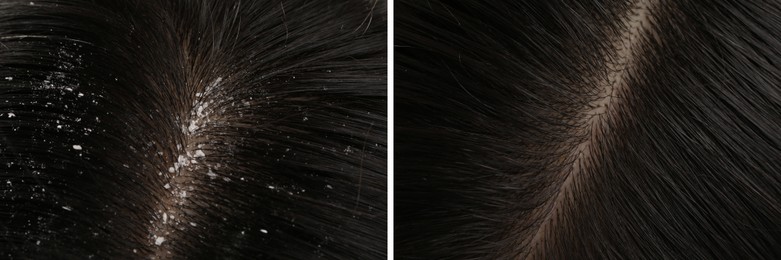 Image of Woman showing hair before and after dandruff treatment, collage