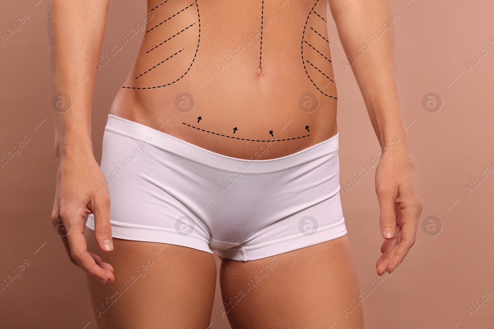 Image of Woman with markings for cosmetic surgery on her abdomen against light brown background, closeup