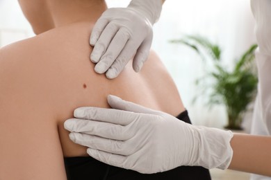 Dermatologist examining patient's birthmark in clinic, closeup