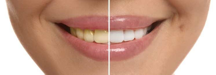 Image of Photo of woman divided in halves before and after tooth whitening on white background, closeup. Collage design