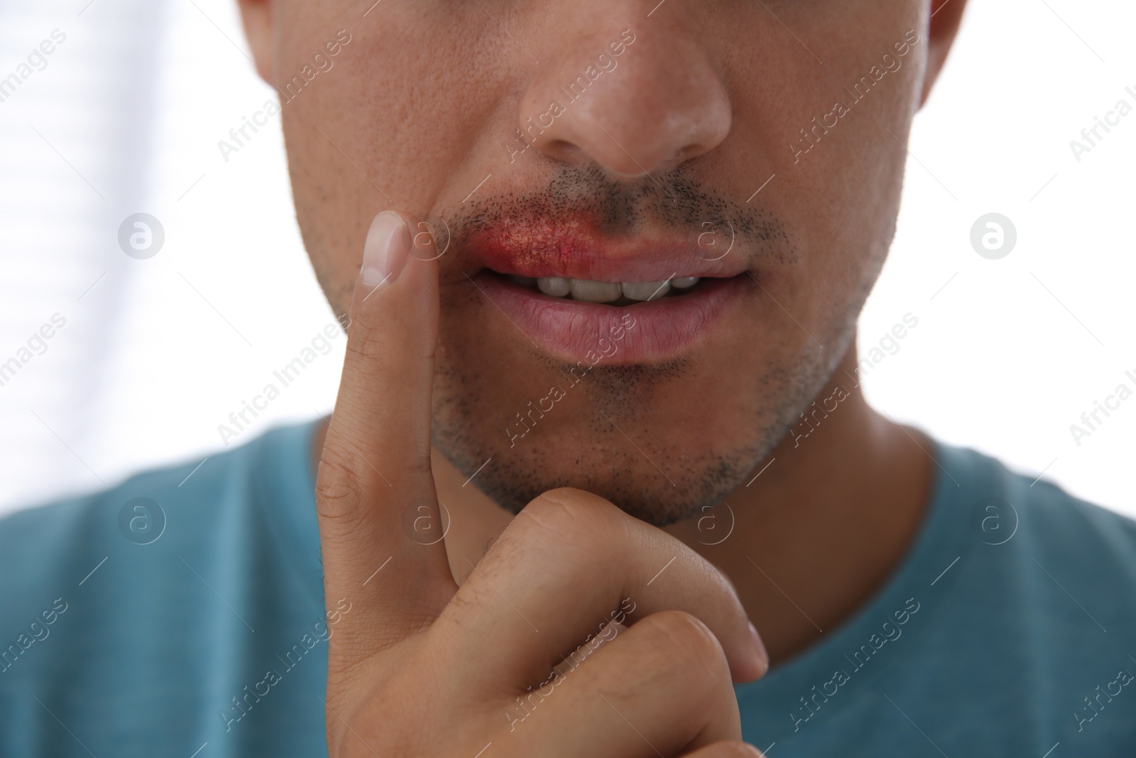 Photo of Man with herpes touching lips against light background, closeup