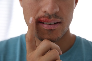 Man with herpes touching lips against light background, closeup