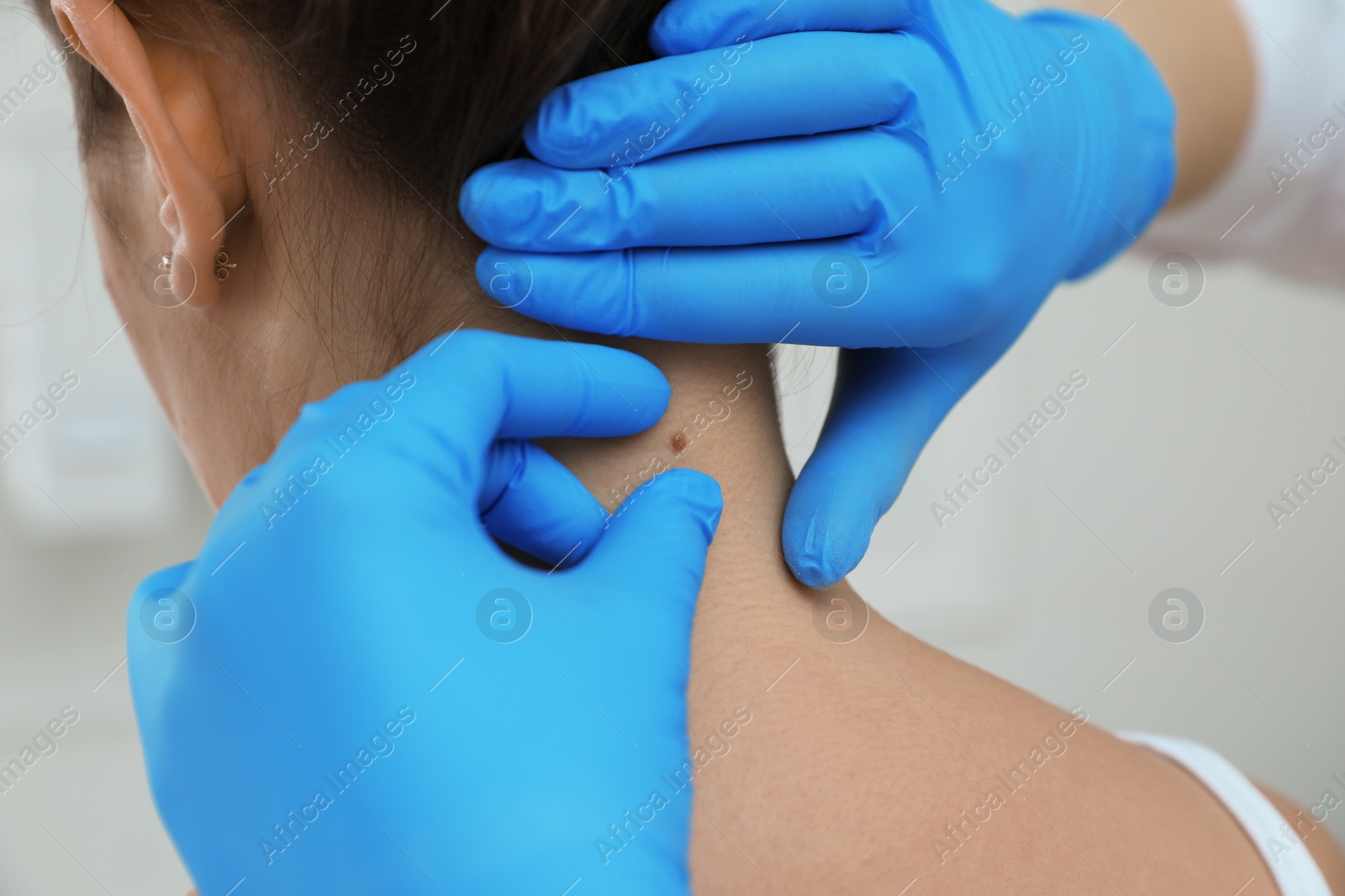 Photo of Dermatologist examining patient's birthmark in clinic, closeup view