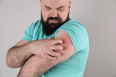Man with allergy symptoms scratching arm on grey background, closeup