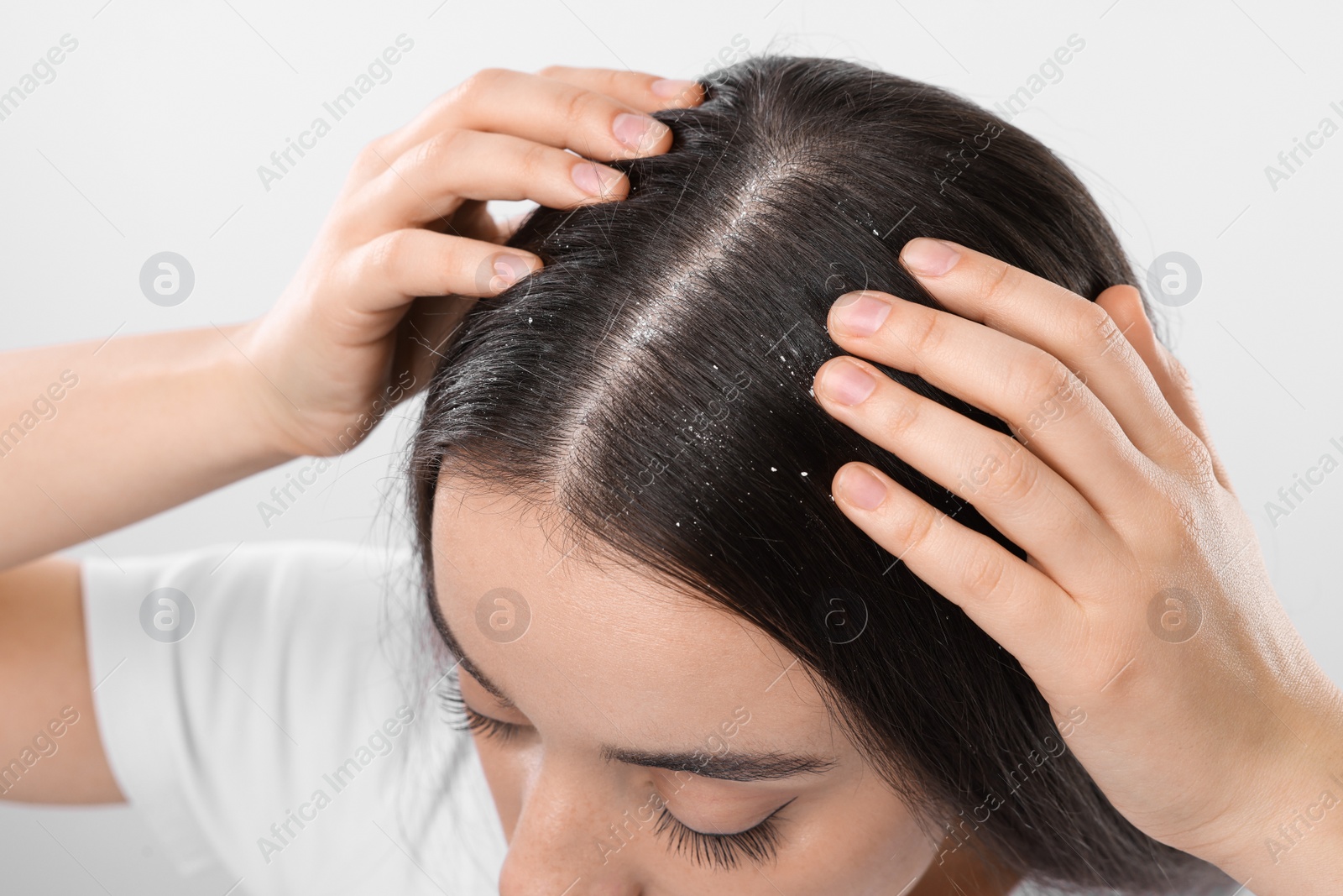 Photo of Woman with dandruff problem on white background, closeup