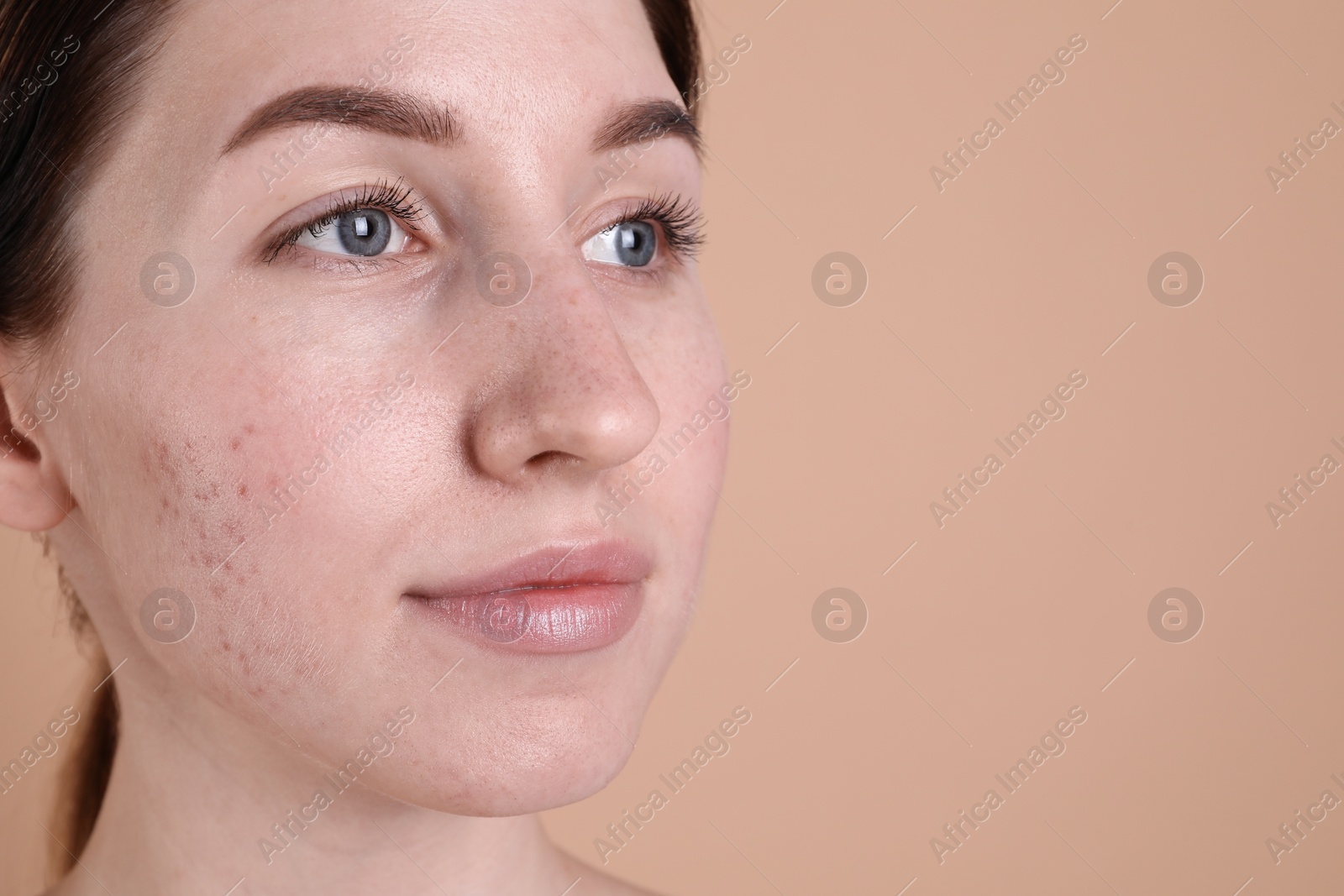 Photo of Young woman with acne problem on beige background, closeup. Space for text