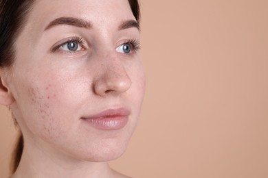 Young woman with acne problem on beige background, closeup. Space for text