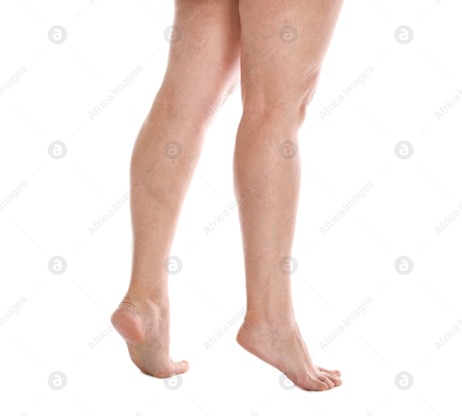 Photo of Woman's legs with varicose on white background, closeup