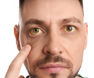 Photo of Man checking his health condition on white background, closeup. Yellow eyes as symptom of problems with liver