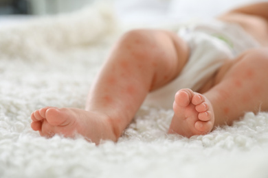 Image of Little child with red rash on bed, closeup. Baby allergies