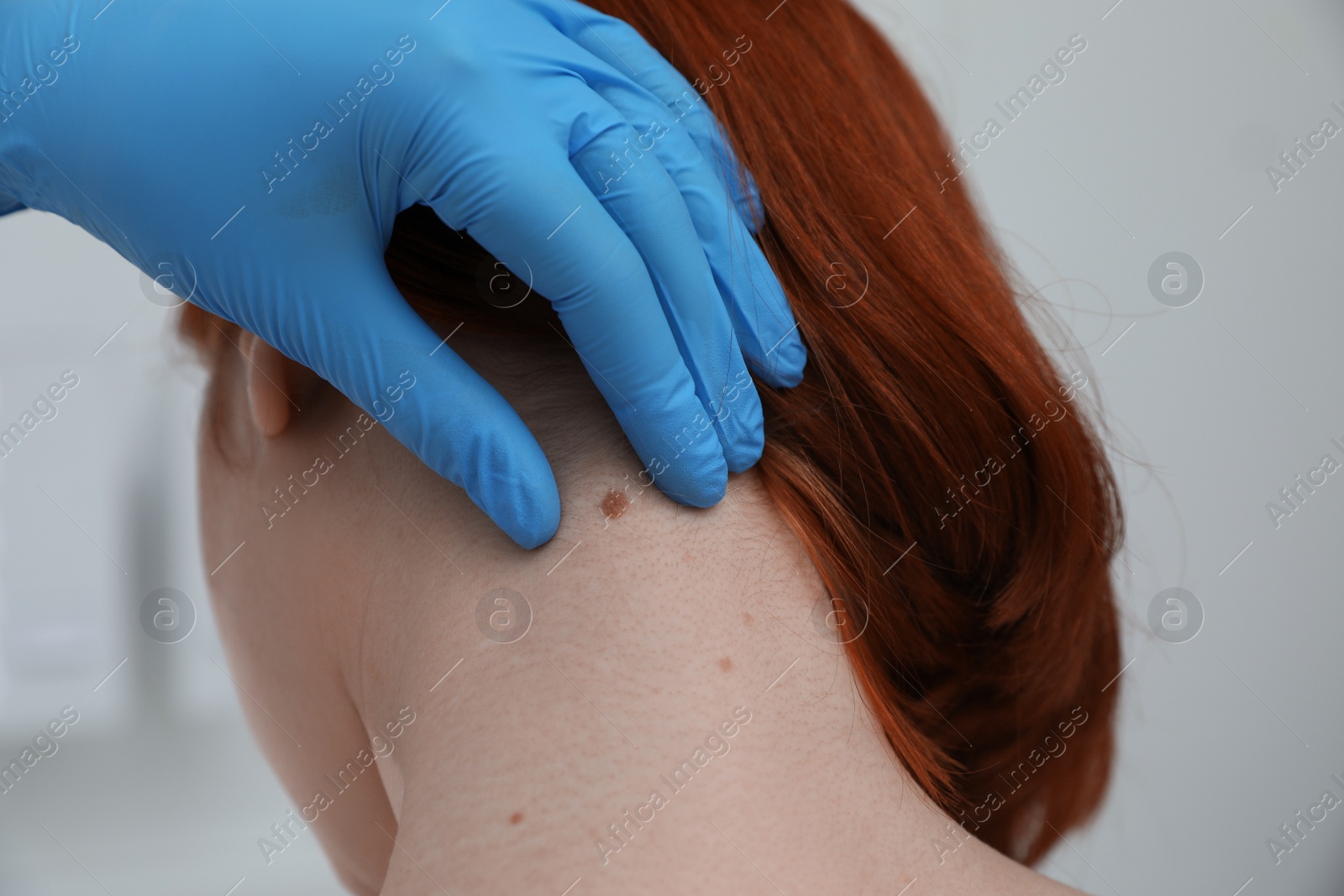 Photo of Dermatologist examining patient's birthmark in clinic, closeup view