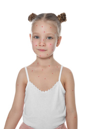 Little girl with chickenpox on white background. Varicella zoster virus