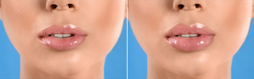 Image of Woman before and after lip correction procedure, closeup. Banner design 