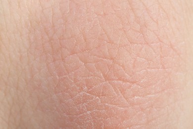 Photo of Texture of healthy skin as background, macro view