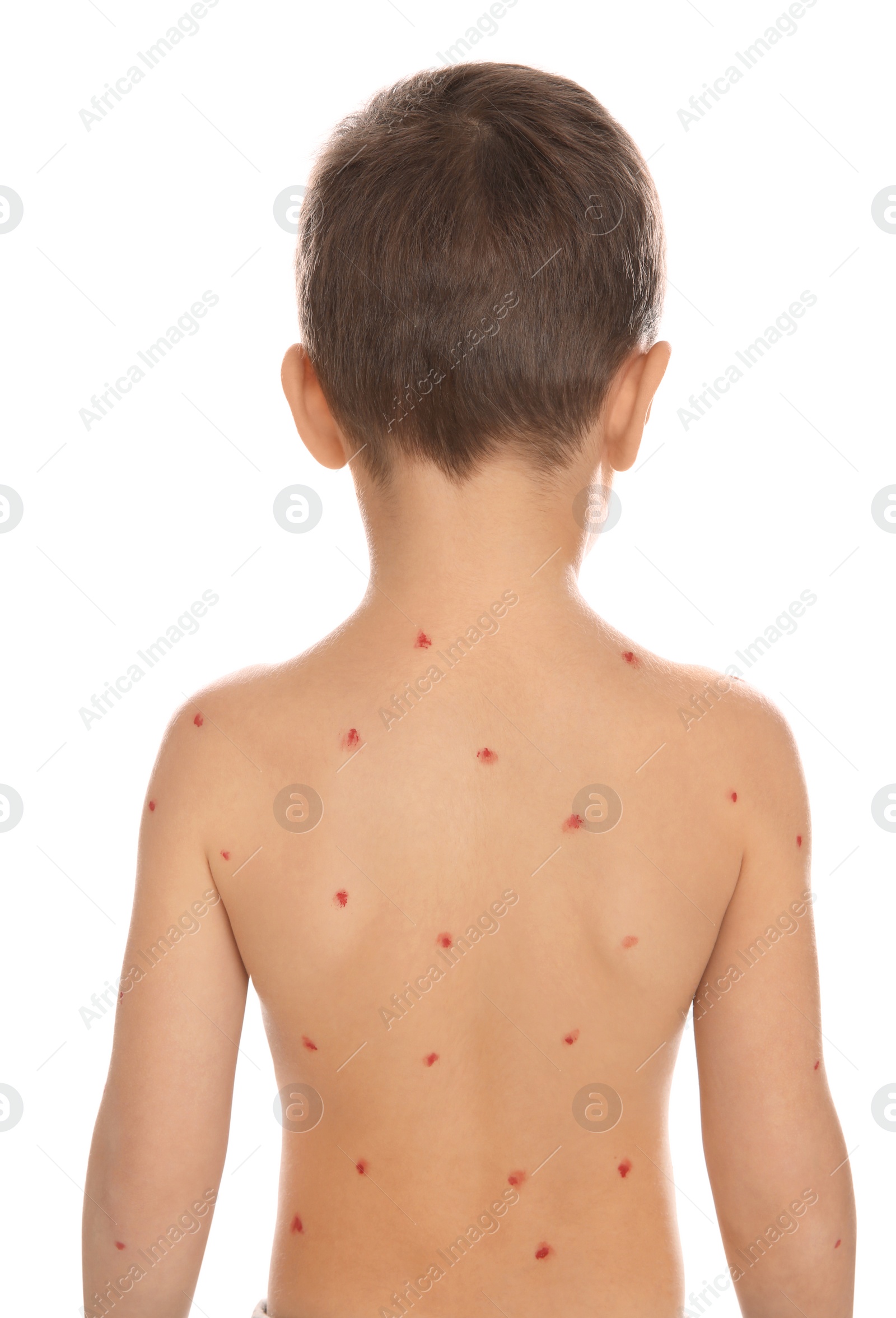 Photo of Little boy with chickenpox on white background