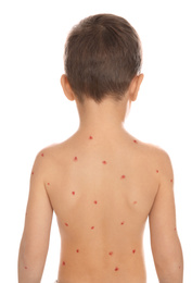 Little boy with chickenpox on white background