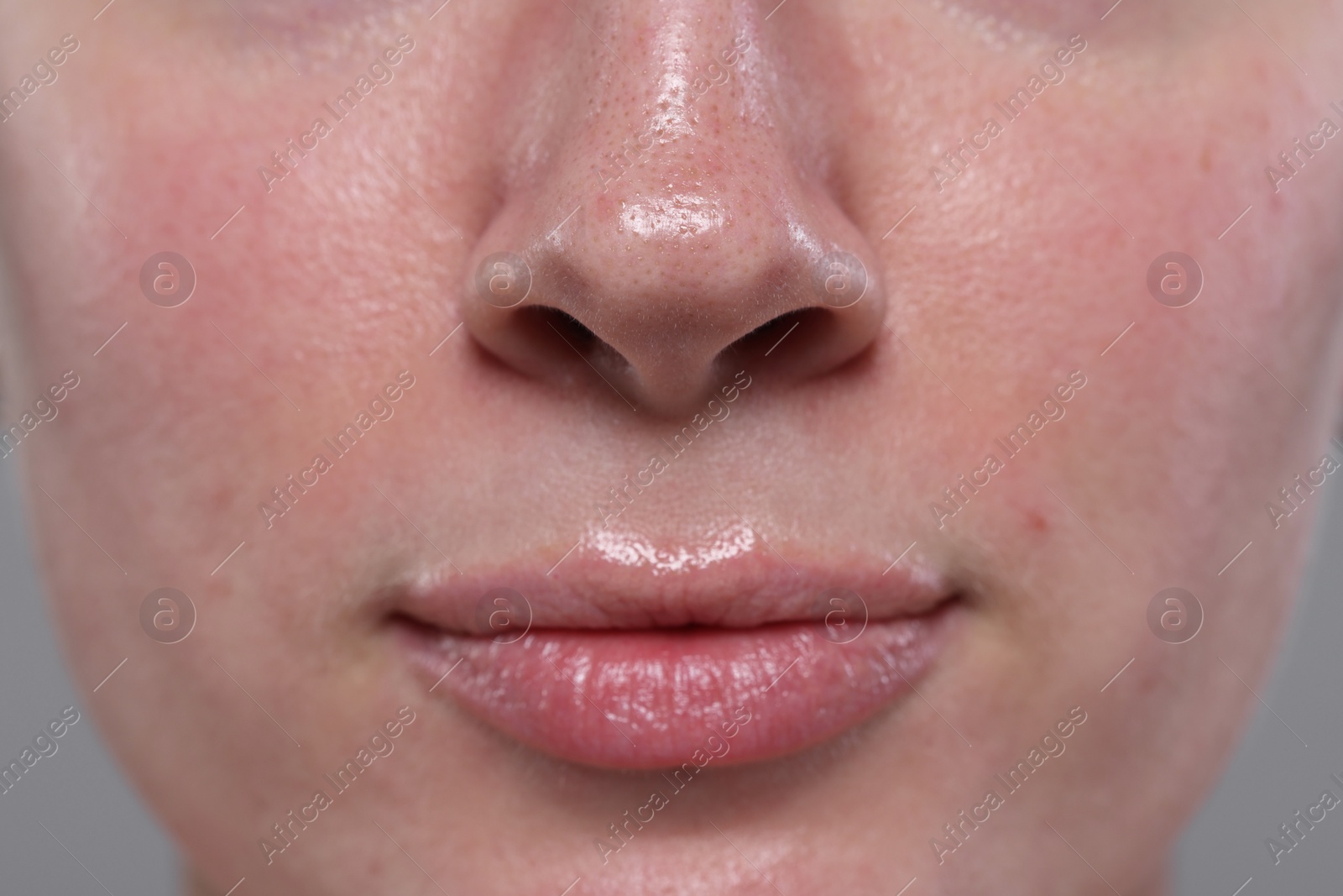 Photo of Closeup view of woman with reddened skin on grey background