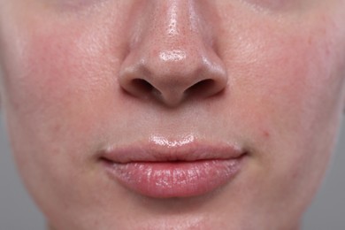 Photo of Closeup view of woman with reddened skin on grey background